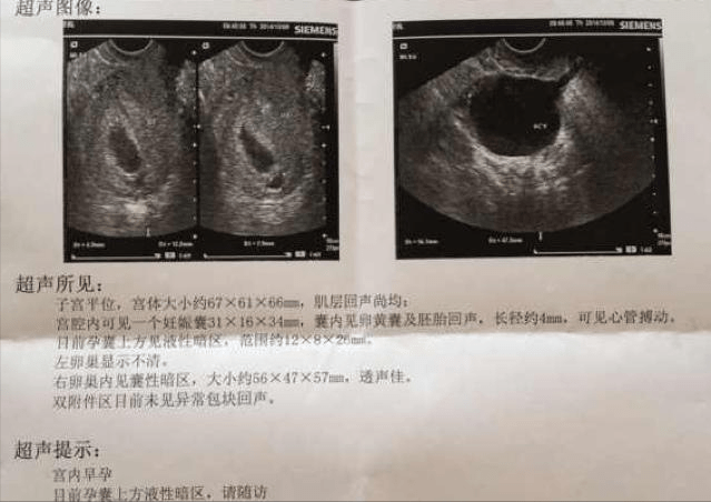 三个月排出的孕囊图片，揭示早期妊娠的微妙变化